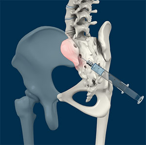 Sacroiliac Joint Injection